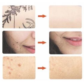 DŁUGOPIS PLAZMOWY DO USUWANIA TATUAŻY ZNAMION PRYSZCZY BIAŁY